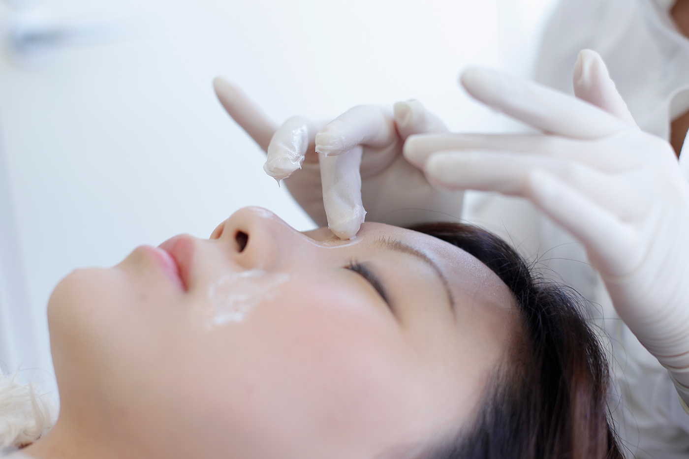 ケミカルピーリング