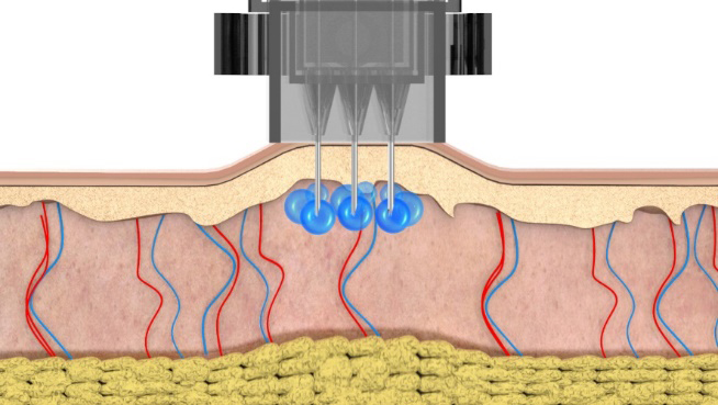 水光注射「BellaVitaInjector」の特長