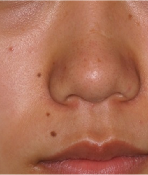顔面に多発するほくろに対して炭酸ガスレーザー治療を施行した症例